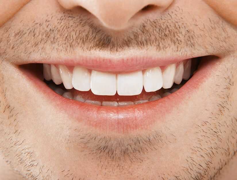 How Often tO Whiten Teeth