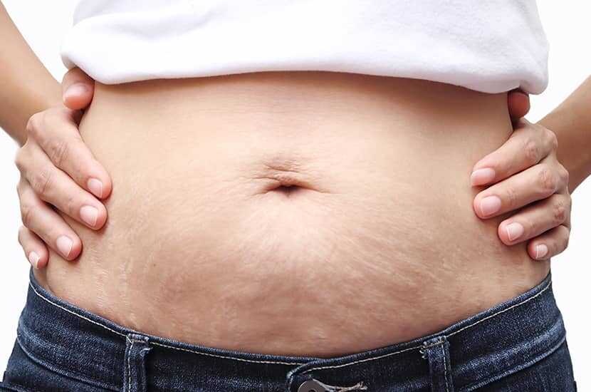 Prevent Stretch Marks Weight Gain