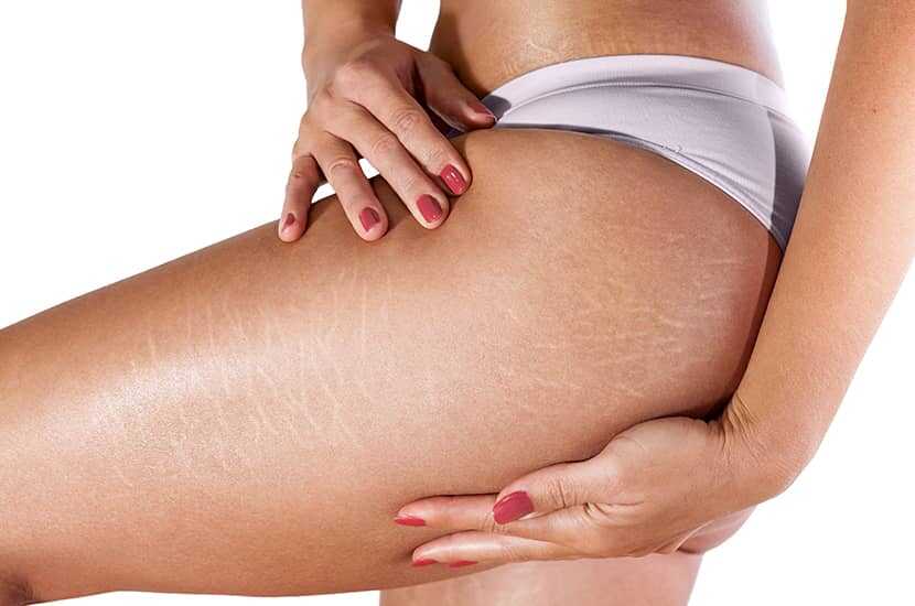 Bodybuilding Stretch Marks: What Are They, And How Can You Prevent Them? | Mealprep