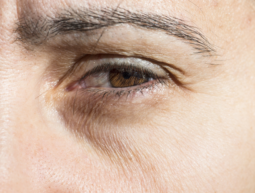 Under Eye Wrinkles